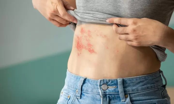 Tres preguntas clave sobre la culebrilla