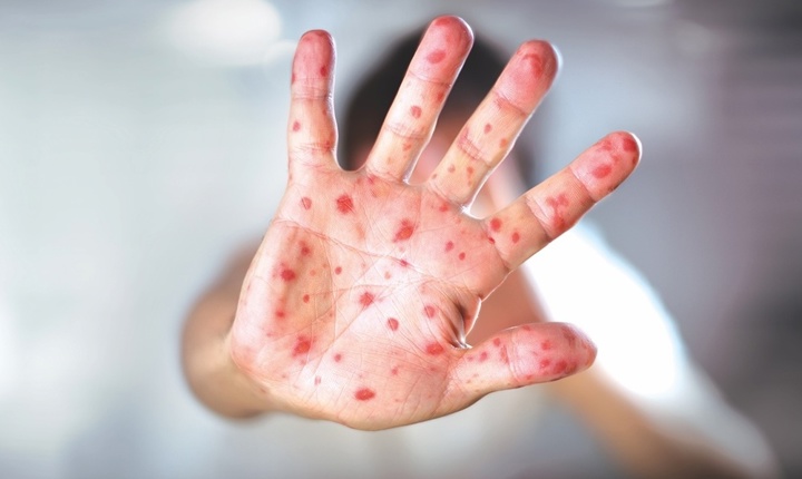 Consejos para proteger a sus hijos contra el sarampión