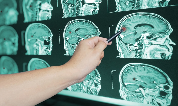 Cómo sobrevivir a un derrame cerebral