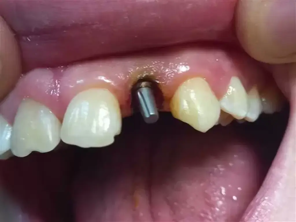 IMPLANTES DENTALES paternal