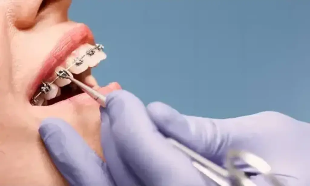 Implantes dentales desde $1999