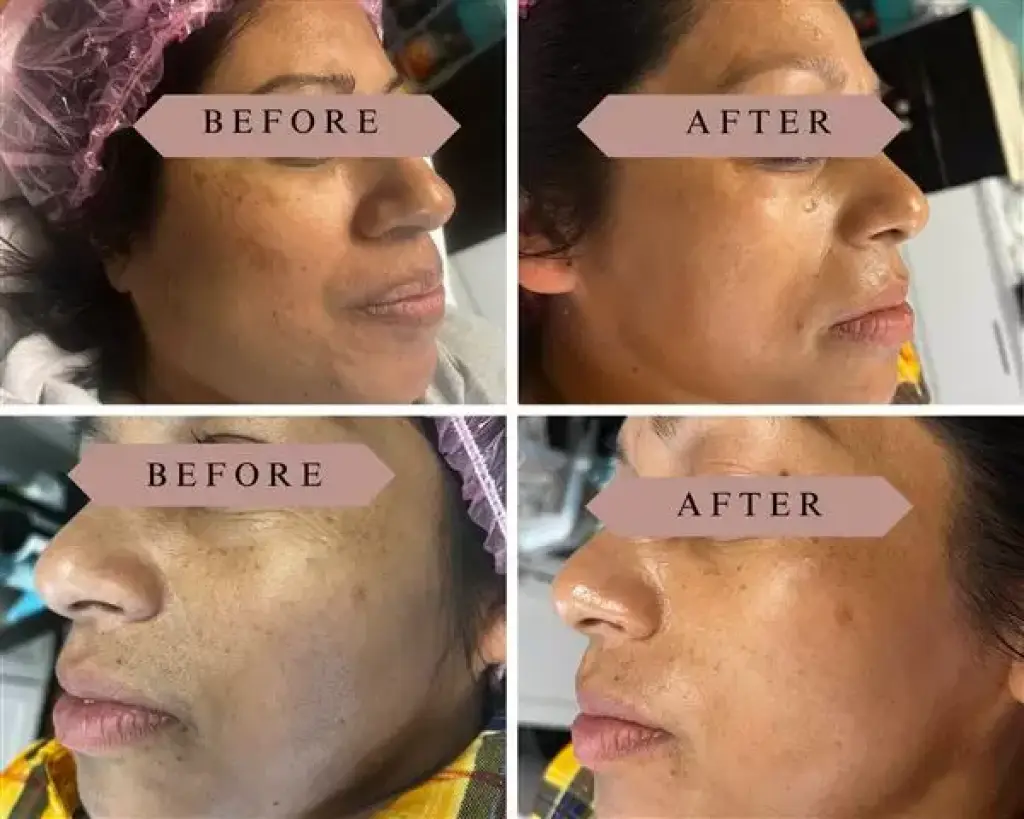 FACIAL LIMPIEZA PROFUNDA