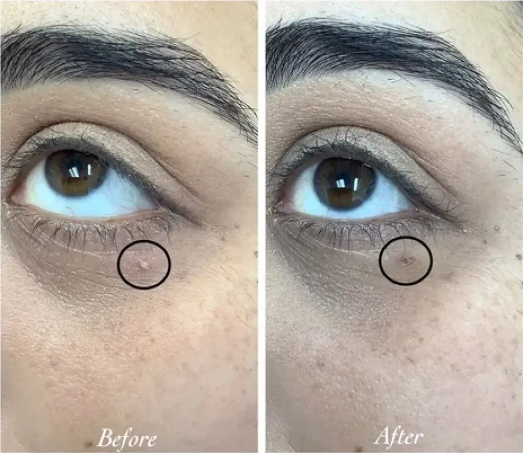 ¿Tienes verrugas irritados?