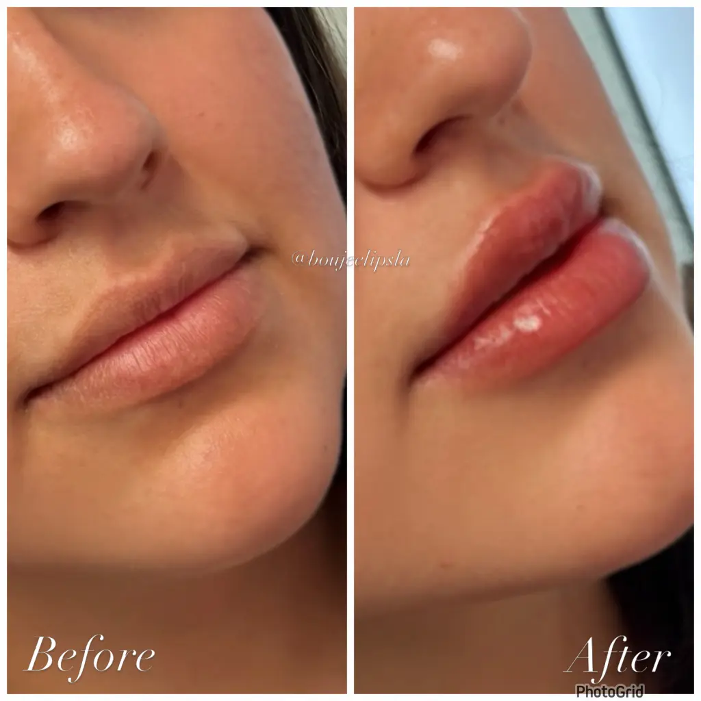 Consigue los labios de tus sueños sin dolor ni agujas!