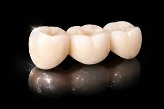 🦷 Coronas Dentales en Pico Rivera — Smile Avenue Dental Group