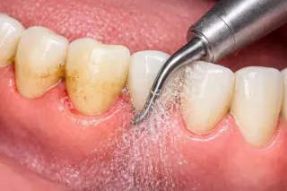 🦷 Limpieza Dental Profesional en Pico Rivera — Smile Avenue Dental Group