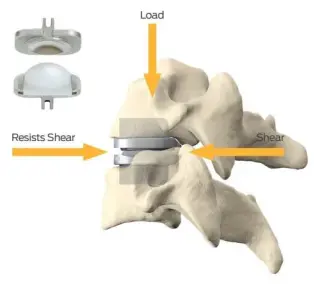 Artificial Disc Replacement Surgeon
