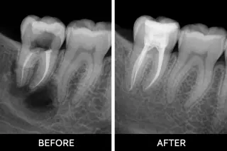 🦷 Tratamiento de Conducto (Root Canal) en Pico Rivera — Smile Avenue Dental Gr