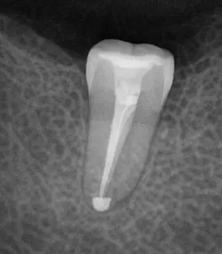 🦷 Tratamiento de Conducto (Root Canal) en Pico Rivera — Smile Avenue Dental Gr