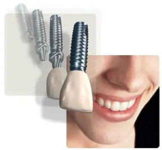 Nueva Sonrisa con Implantes dentales.