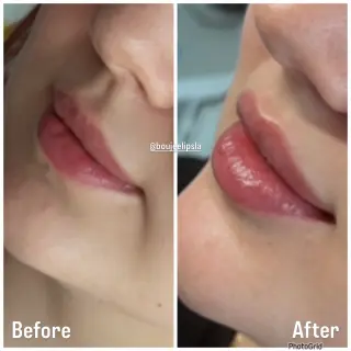 Consigue los labios de tus sueños sin dolor ni agujas!