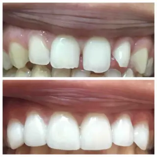🦷 Coronas Dentales en Pico Rivera — Smile Avenue Dental Group
