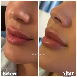 Consigue los labios de tus sueños sin dolor ni agujas!