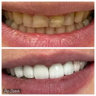 🦷 Coronas Dentales en Pico Rivera — Smile Avenue Dental Group