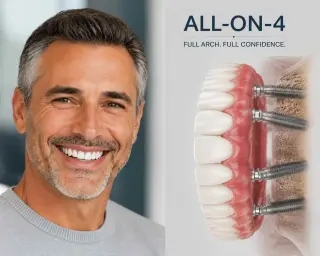 ¡Implantes Dentales en Pico Rivera — Smile Avenue Dental Group!