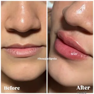 Consigue los labios de tus sueños sin dolor ni agujas!