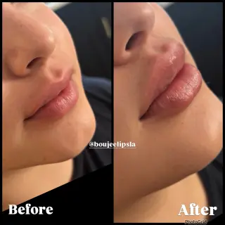 Consigue los labios de tus sueños sin dolor ni agujas!
