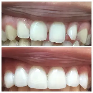 🦷 Coronas Dentales en Pico Rivera — Smile Avenue Dental Group