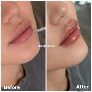 Consigue los labios de tus sueños sin dolor ni agujas!