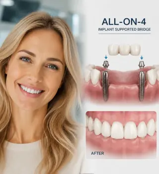 ¡Implantes Dentales en Pico Rivera — Smile Avenue Dental Group!