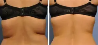 LIPO MASAJE MOLDEA TU CUERPO
