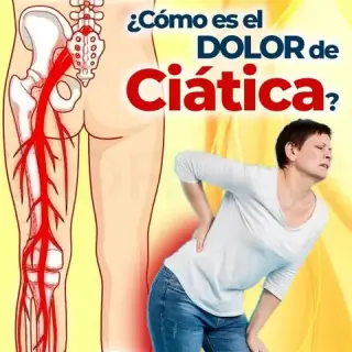 DOLOR MUSCULAR CIATICA