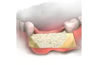 Implante dental en Escondido
