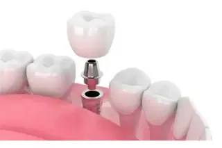 Implante dental en Escondido