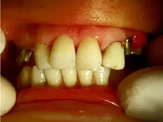 ODONTOLOGIA PRIVADA IMPLANTES