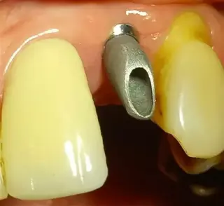 IMPLANTES DENTALES paternal