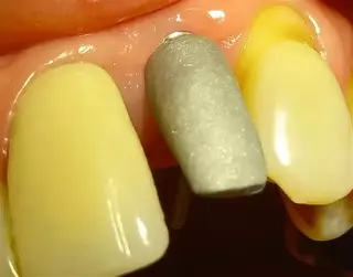 IMPLANTES DENTALES paternal