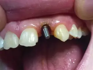 IMPLANTES DENTALES NACIONALES