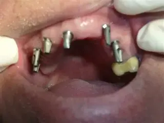 IMPLANTES DENTALES NACIONALES