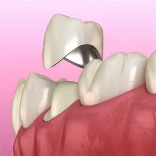 Implantes Dentales en Rialto