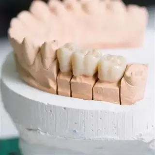 Implantes Dentales en Rialto