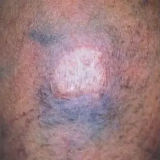 ¿VÁRICES EN LAS PIERNAS?