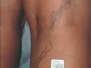 ¿VÁRICES EN LAS PIERNAS?
