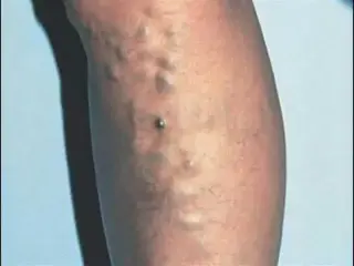 ¿VÁRICES EN LAS PIERNAS?
