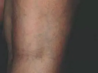 ¿VÁRICES EN LAS PIERNAS?