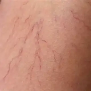 ¿VÁRICES EN LAS PIERNAS?