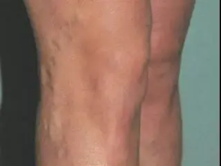 ¿VÁRICES EN LAS PIERNAS?