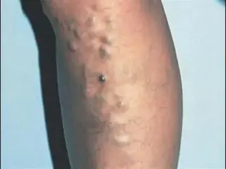 ¿Tiene dolores en las piernas?