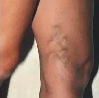¿Tiene dolores en las piernas?