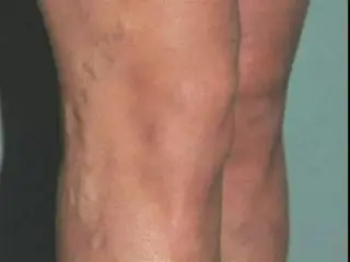 ¿Tiene dolores en las piernas?
