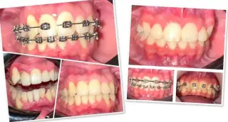 Implantes dentales desde $1999