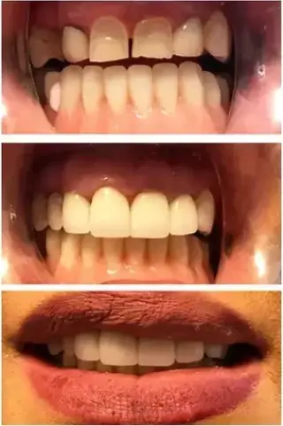 Implantes dentales desde $1999