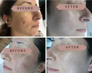 DEPILACION PARA HOMBRE/MUJER