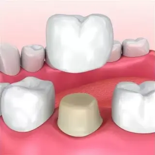 Implantes Dentales desde $799