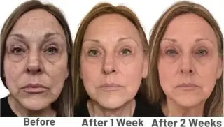 NEO FILLER ALTERNATIVA A BOTOX