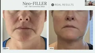 NEO FILLER ALTERNATIVA A BOTOX